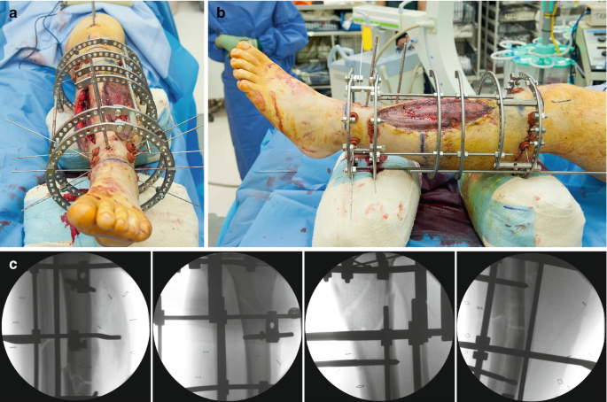 Full ring external fixation (Ilizarov) for Extraarticular, wedge fracture