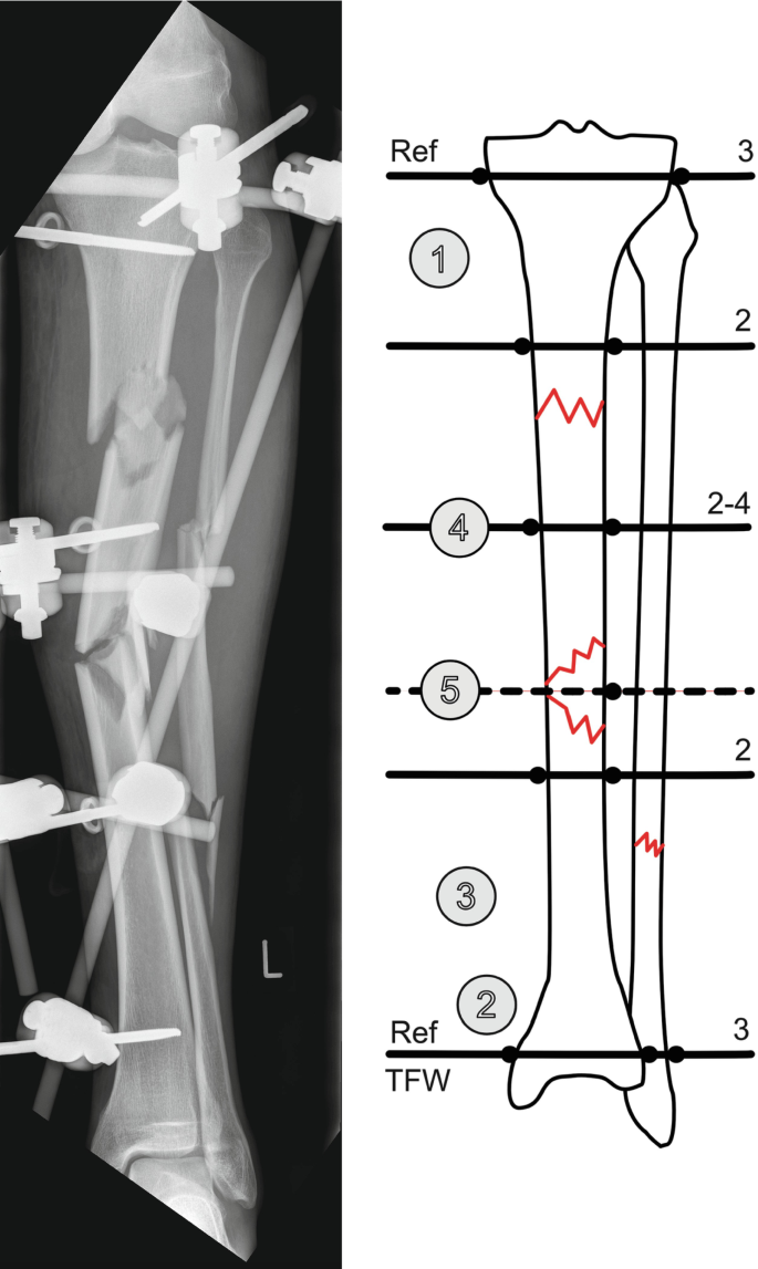 Tibia Fractures: Ilizarov / Circular Wire Fixators : Wheeless' Textbook of  Orthopaedics