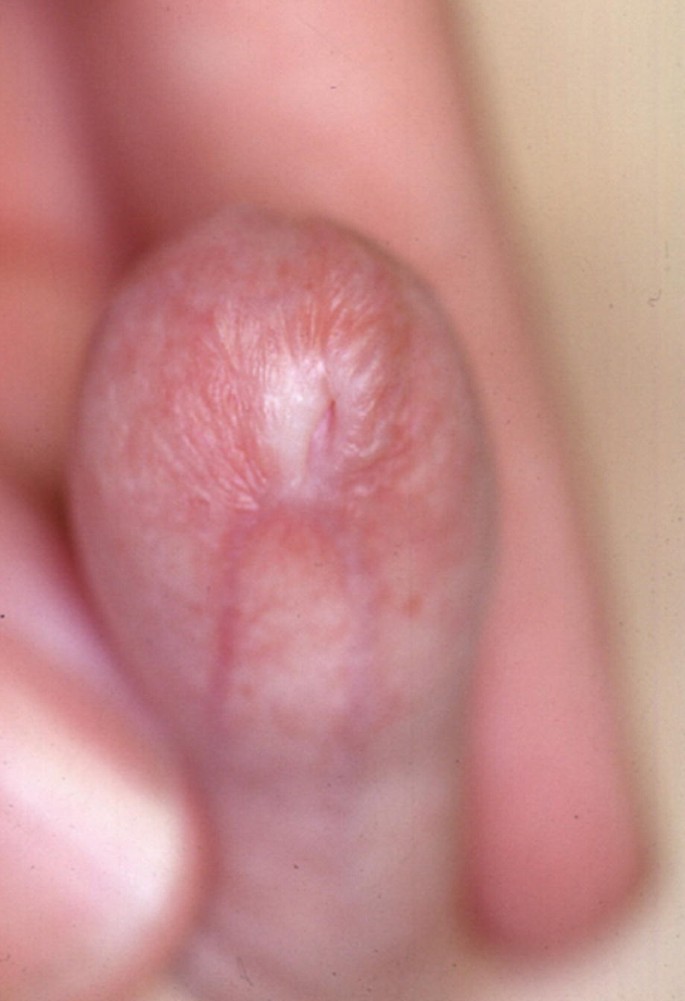 What are these small lumps under my foreskin?
