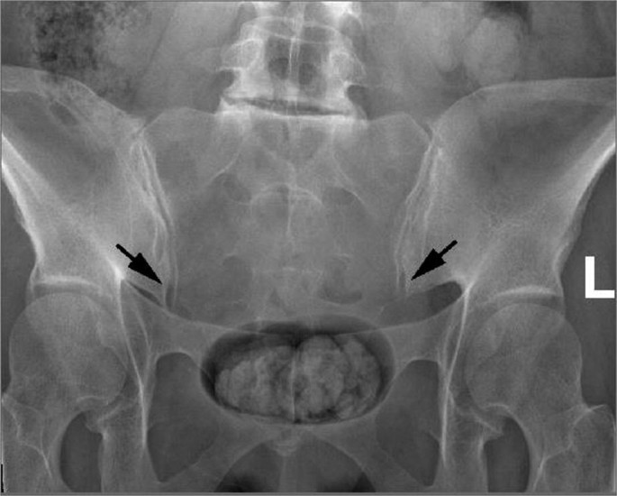 ferguson view of lumbar spine