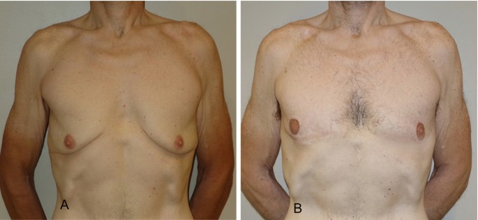 Gynecomastia After Massive Weight Loss: Reshaping with Intercostal  Perforator Flaps