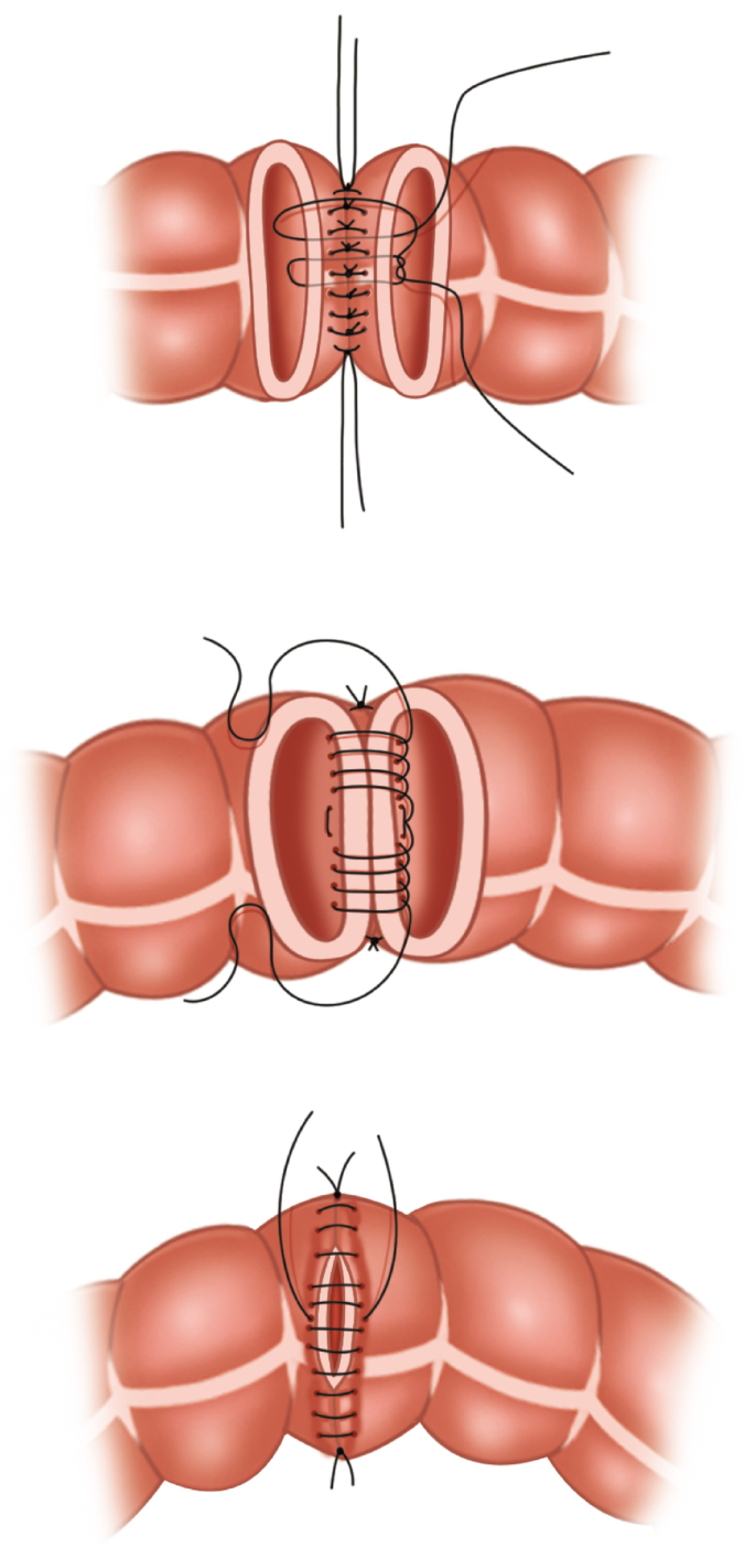 Placement of purse string suture in right atrium. | Download Scientific  Diagram