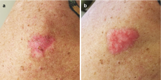 Cryotherapy and Electrodesiccation Curettage Basal Carcinoma | SpringerLink