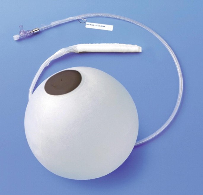Air-Filled Intragastric Balloon Implant | SpringerLink
