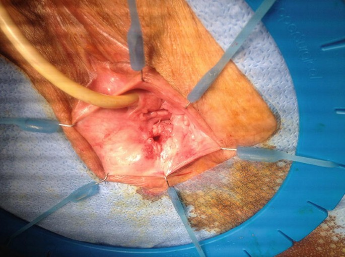 Laparoscopic Resection of an Epidermal Inclusion Cyst at the