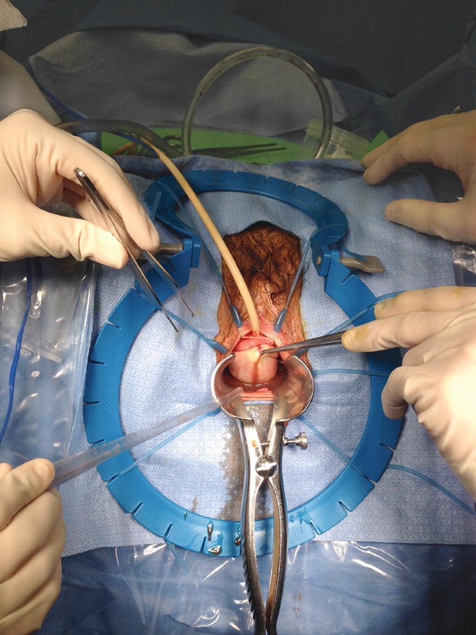 Excision of Vaginal and Vulvar Cysts