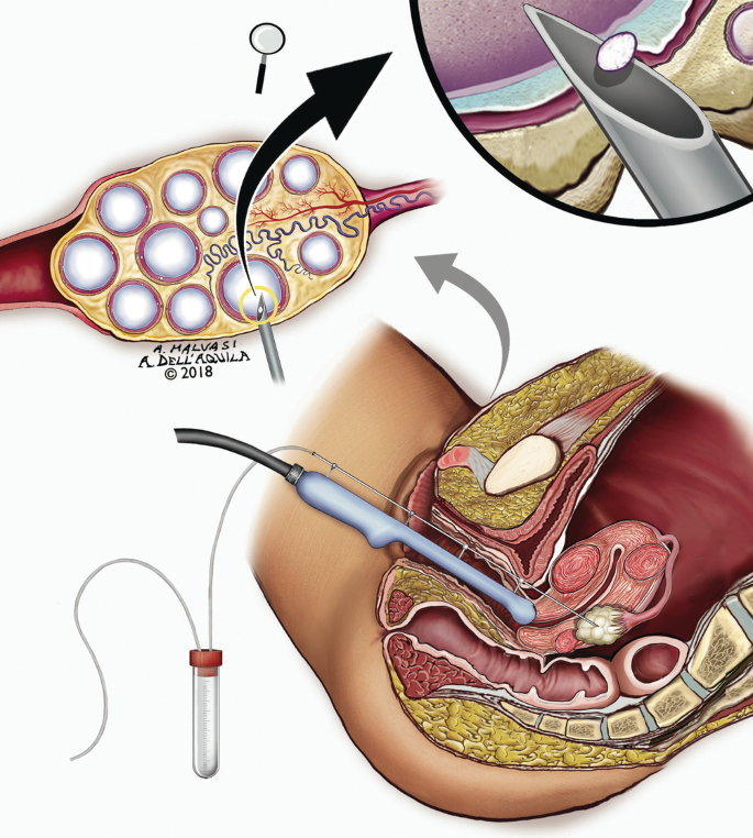 Gynaecological needles - Vitrolife