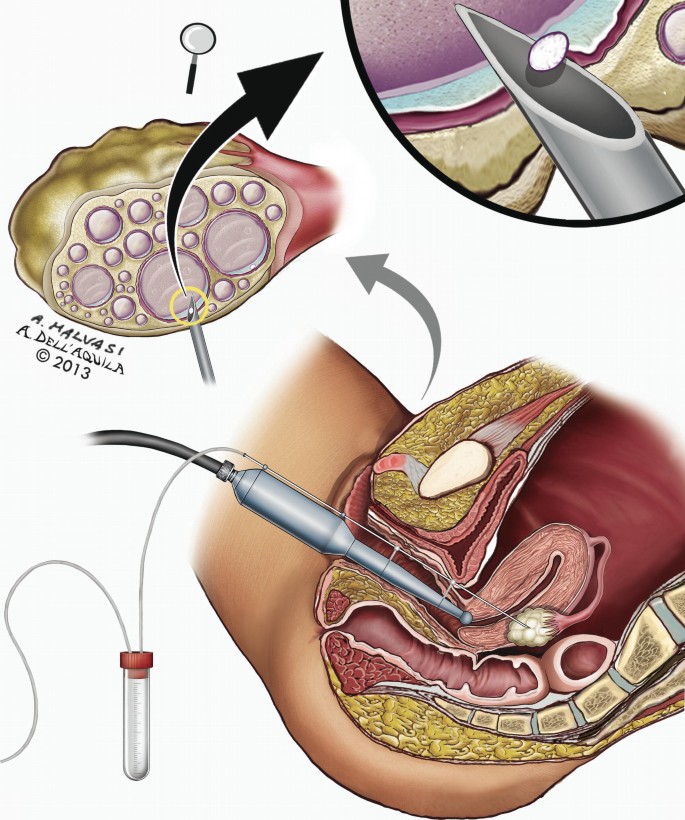 Anesthesia and Analgesia for Women Undergoing Oocyte Retrieval