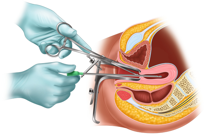 Manual Vacuum Aspiration (MVA) Abortion | SpringerLink