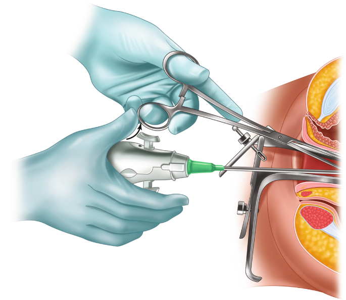 Manual Vacuum Aspiration (MVA) Abortion | SpringerLink