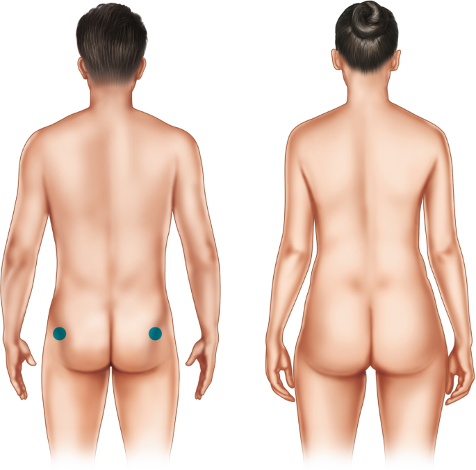 Male-to-Female Breast Augmentation and Body Contouring | SpringerLink