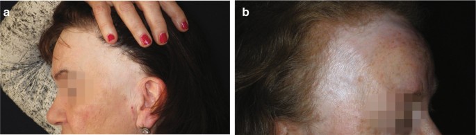 Hair Loss and Hair Growth | SpringerLink Hair Loss and Hair Growth | SpringerLink