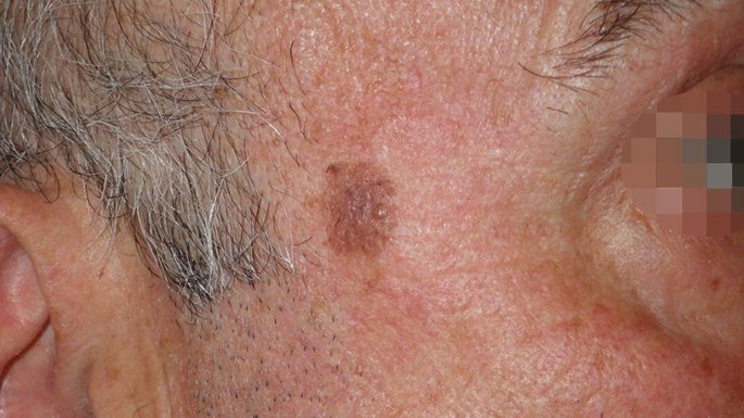 Cancer and Pre-Cancer of the Skin | Springer Nature Link