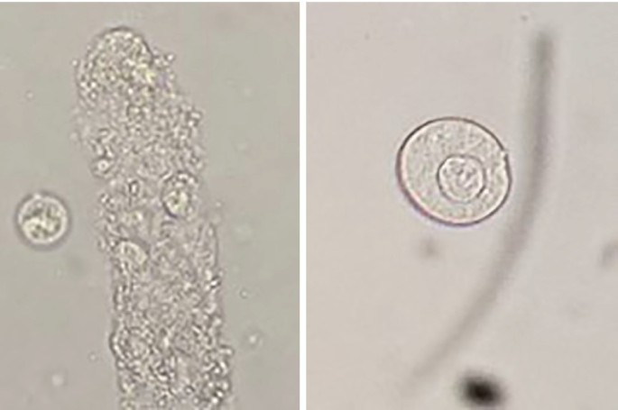 Urine Microscopy: The Utility of Urinary Casts in Patient Care – Practical  and Useful Tips for Busy Clinicians | SpringerLink