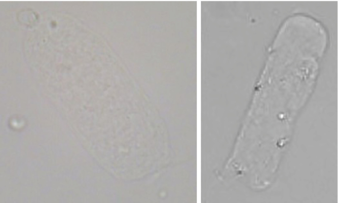 Urine Microscopy: The Utility of Urinary Casts in Patient Care – Practical  and Useful Tips for Busy Clinicians | SpringerLink