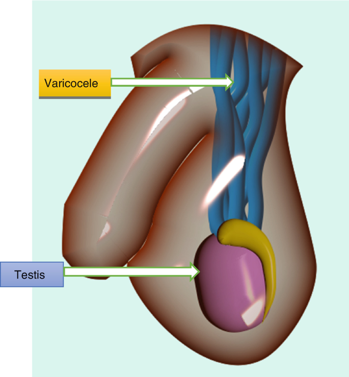Causes & Treament of Varicocele | Georgiadis Urology