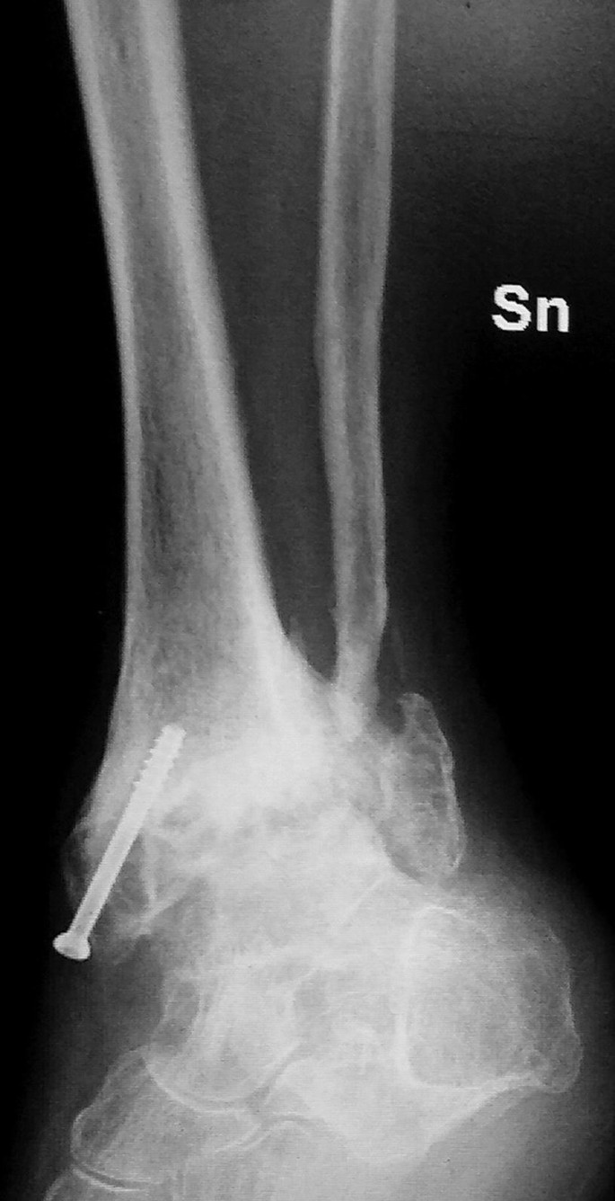 Figure 3 from The success of tibiotalocalcaneal arthrodesis with  intramedullary nailing--a systematic review of the literature. | Semantic  Scholar