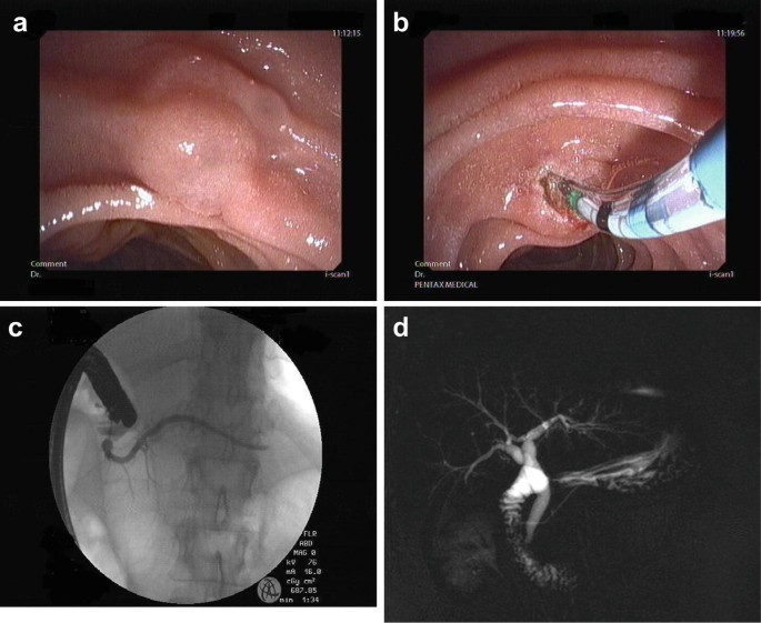 glp-1 agonist side fffect pancretitis Ozempic and Pancreatitis: Can Semaglutide Cause Pancreatitis?
