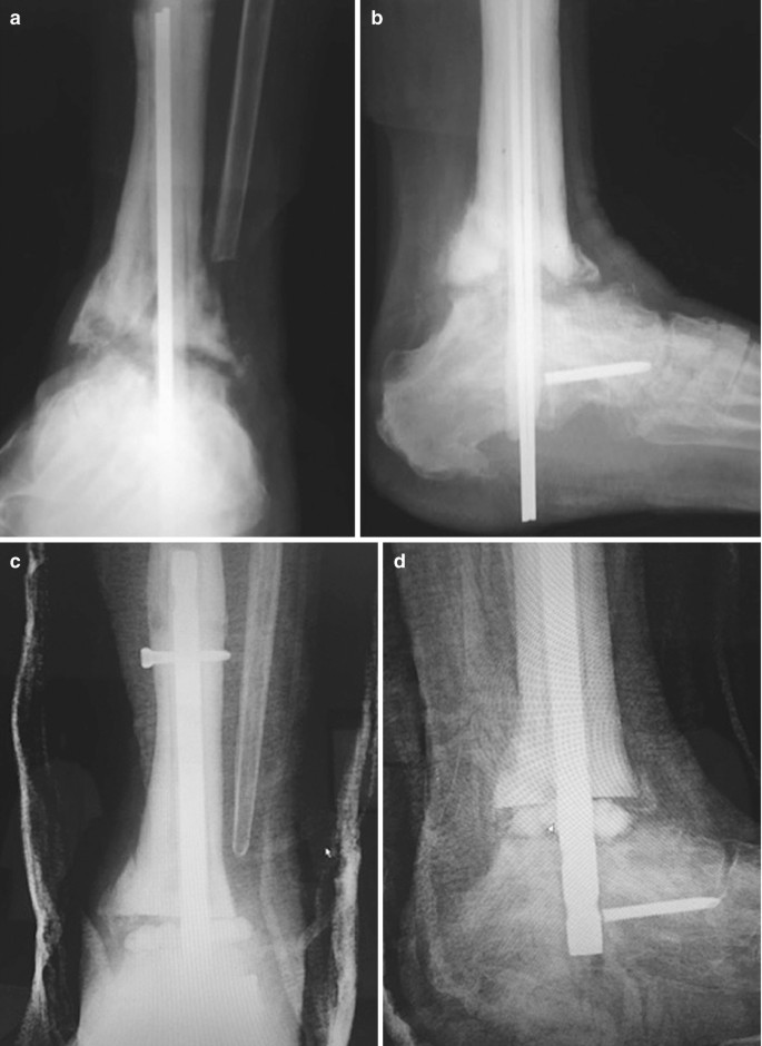 Revision of Nonunion and Malunion: Ankle Arthrodesis | SpringerLink Revision of Nonunion and Malunion: Ankle Arthrodesis | SpringerLink
