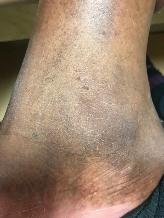 Cutaneous Infections in Black Skin | SpringerLink