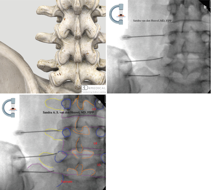 Lumbar Medial Branch Block and Radiofrequency Ablation | SpringerLink