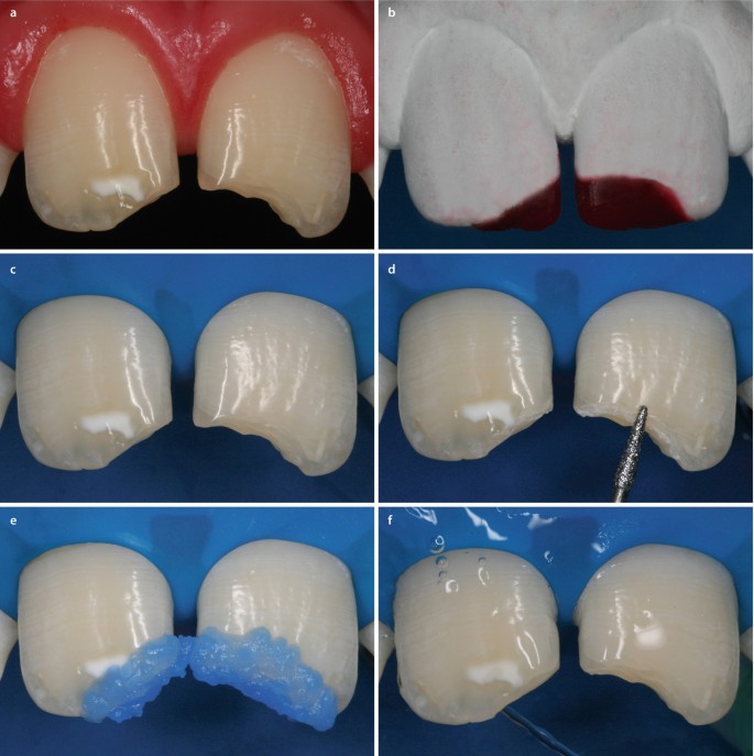 Dental Composite Bonding Microbrushes 45-Pack