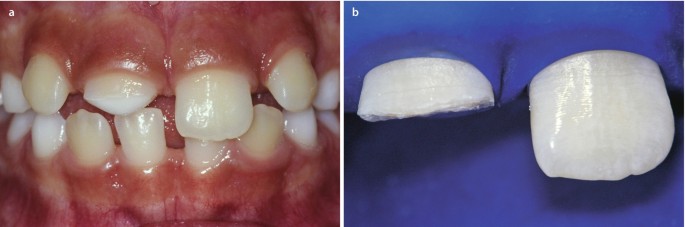Composite Restoration on Anterior Teeth | SpringerLink