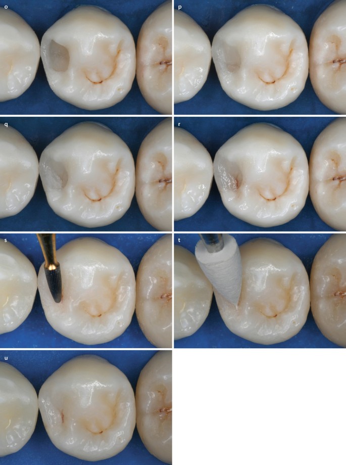 Caries Teeth Dental Model Composite Resin Restoration Of Decay Tooth Simulate Class Ⅱ Matrix Ring Sectional (Standard Ring 1piece