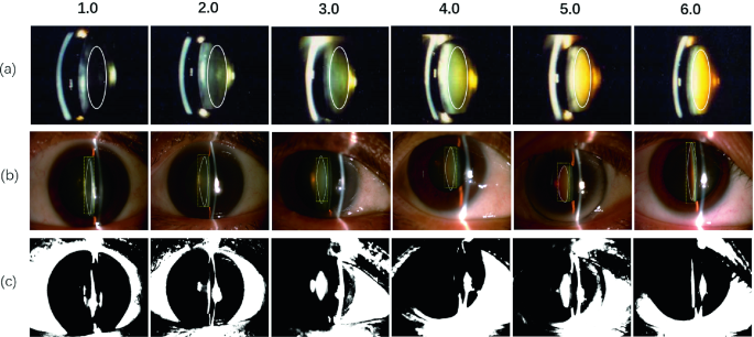Fully Deep Learning for Slit-Lamp Photo Based Nuclear Cataract Grading |  SpringerLink