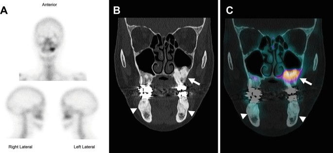Benign Jaw Tumors: Types | Springer Nature Link
