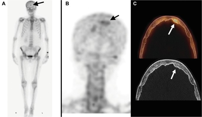 Tumors and Tumor-Like Lesions in the Skull
