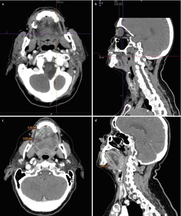 Diagnostic Imaging of Oral Squamous Cell Carcinoma | SpringerLink