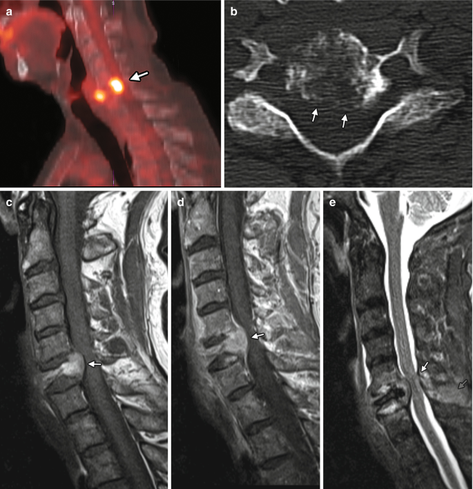 Differentiation of acute and chronic vertebral compression fractures using  conventional CT based on deep transfer learning features and hand-crafted  radiomics features, BMC Musculoskeletal Disorders
