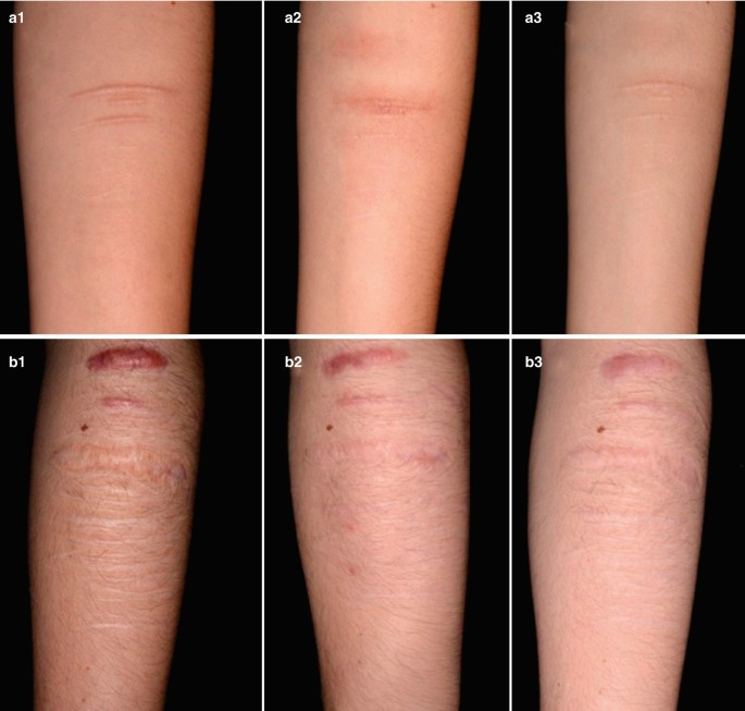 Laser Treatment of Scars | SpringerLink