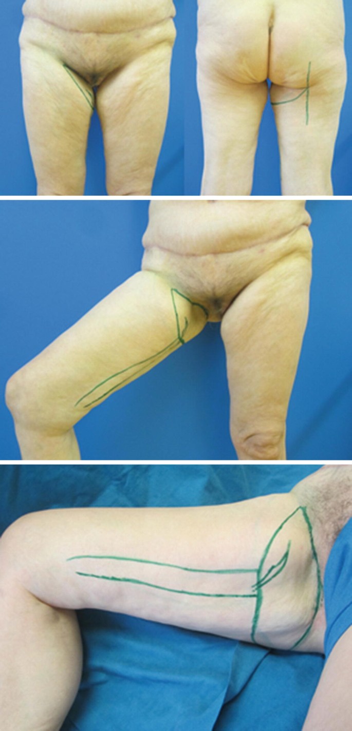 Thigh scar in breast reconstruction surgery - Stock Image - C038