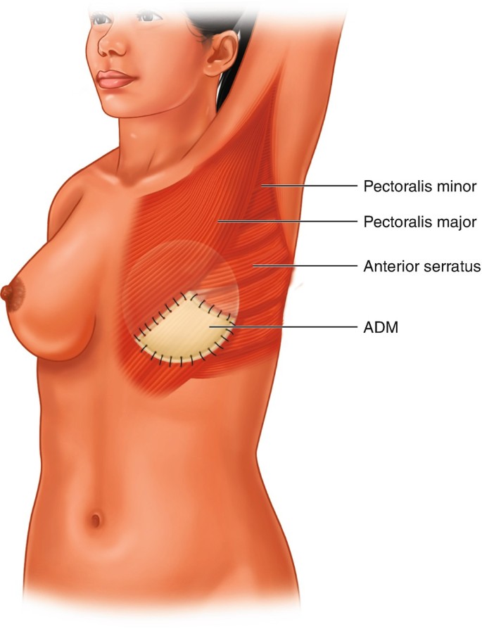 Biologic Meshes in Breast Reconstruction