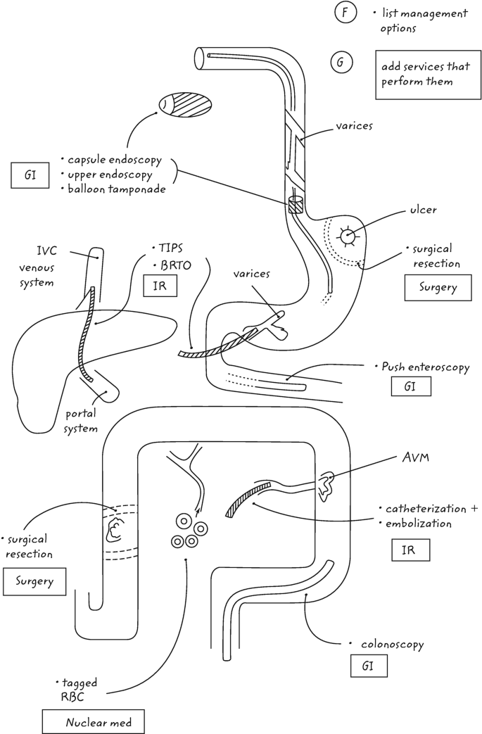 An illustration of the management of G I bleeding. Treatment depends on the causes and includes surgery, endoscopy, colonoscopy, and nuclear medicine.