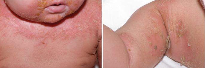 Infection: Bacteria, Spirochetes, Protozoa, and Infestation ...