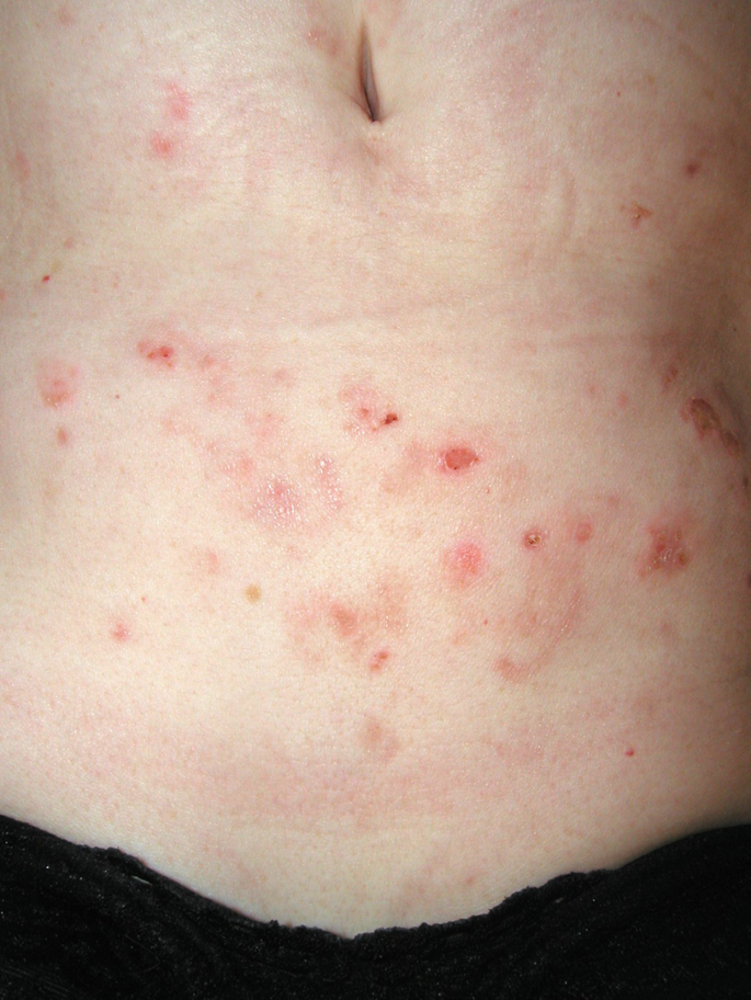 Confluent erythematous papules merging on the lower abdominal