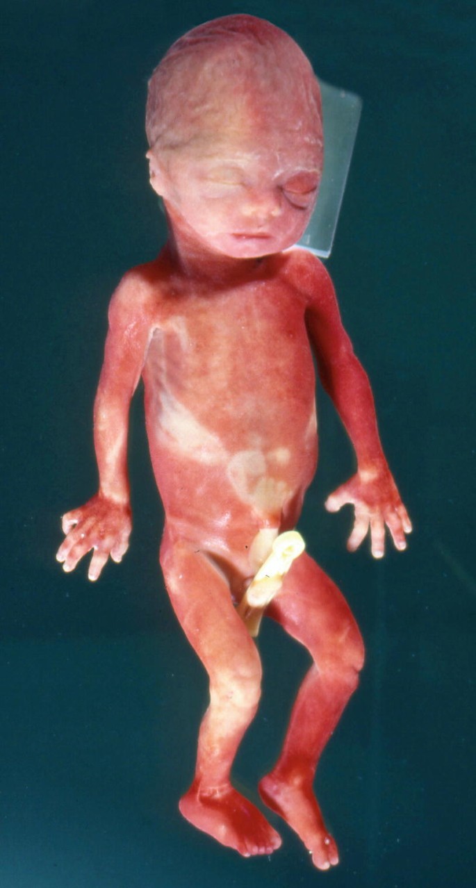 📃 Trisomy 21 - severe form, 33 weeks