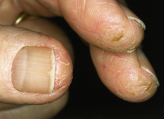 Seborrheic Dermatitis and HIV Infection