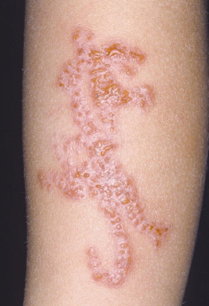 Clinical Features of Contact Dermatitis | SpringerLink Clinical Features of Contact Dermatitis | SpringerLink