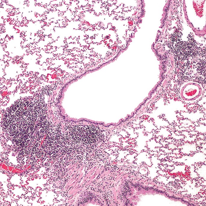 Malignant Hematopoietic Disorders of the Lung | SpringerLink