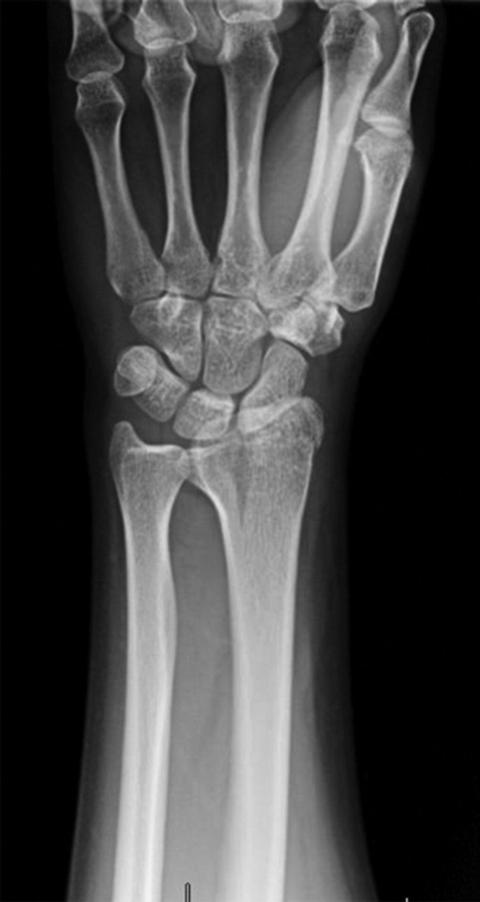 Ulnar nerve palsy as a complication of closed both-bone forearm fractu |  IMCRJ