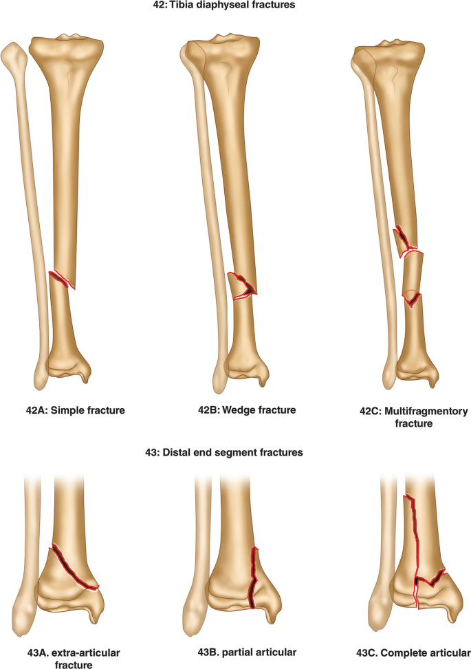 AO/OTA classification of tibial diaphyseal fractures. 9