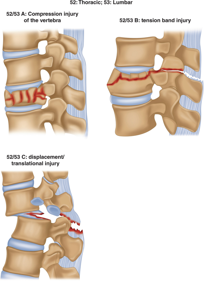 Thoracic Spine Fractures & Injuries