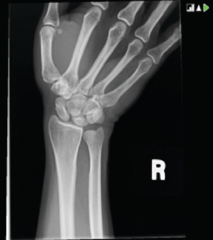 A case of bilateral elbow dislocation in a patient with Rubinstein