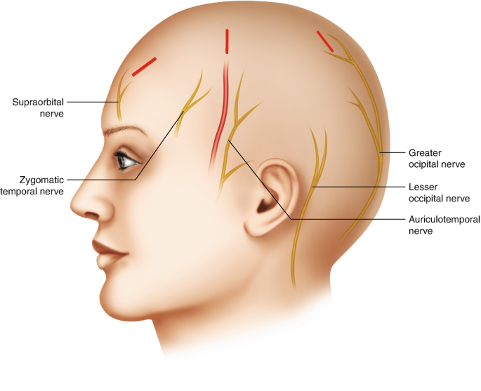 Nummular Headache | SpringerLink