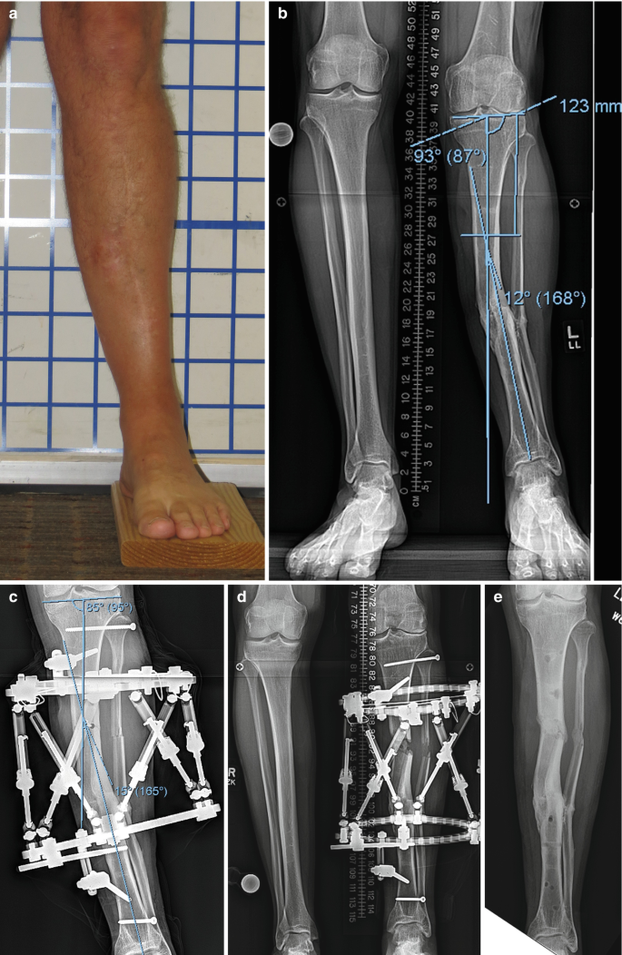 Full ring external fixation (Ilizarov) for Extraarticular, wedge fracture