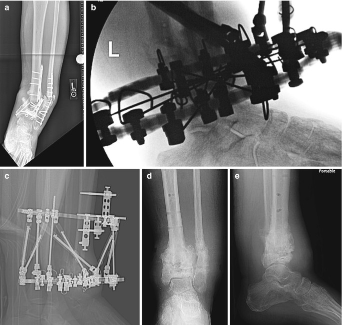 Full ring external fixation (Ilizarov) for Extraarticular, wedge